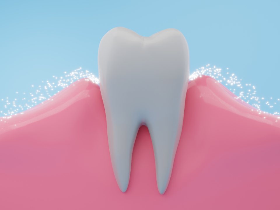 parodontite - infiammazione gengive