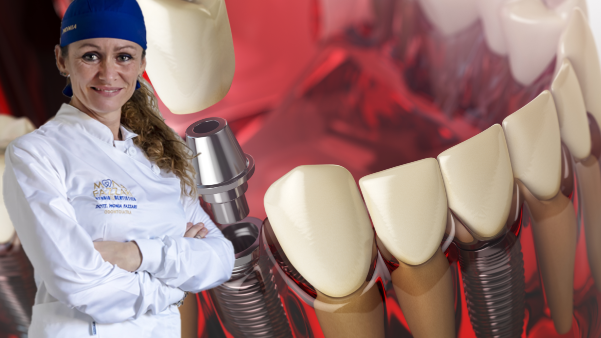 impianti dentali
