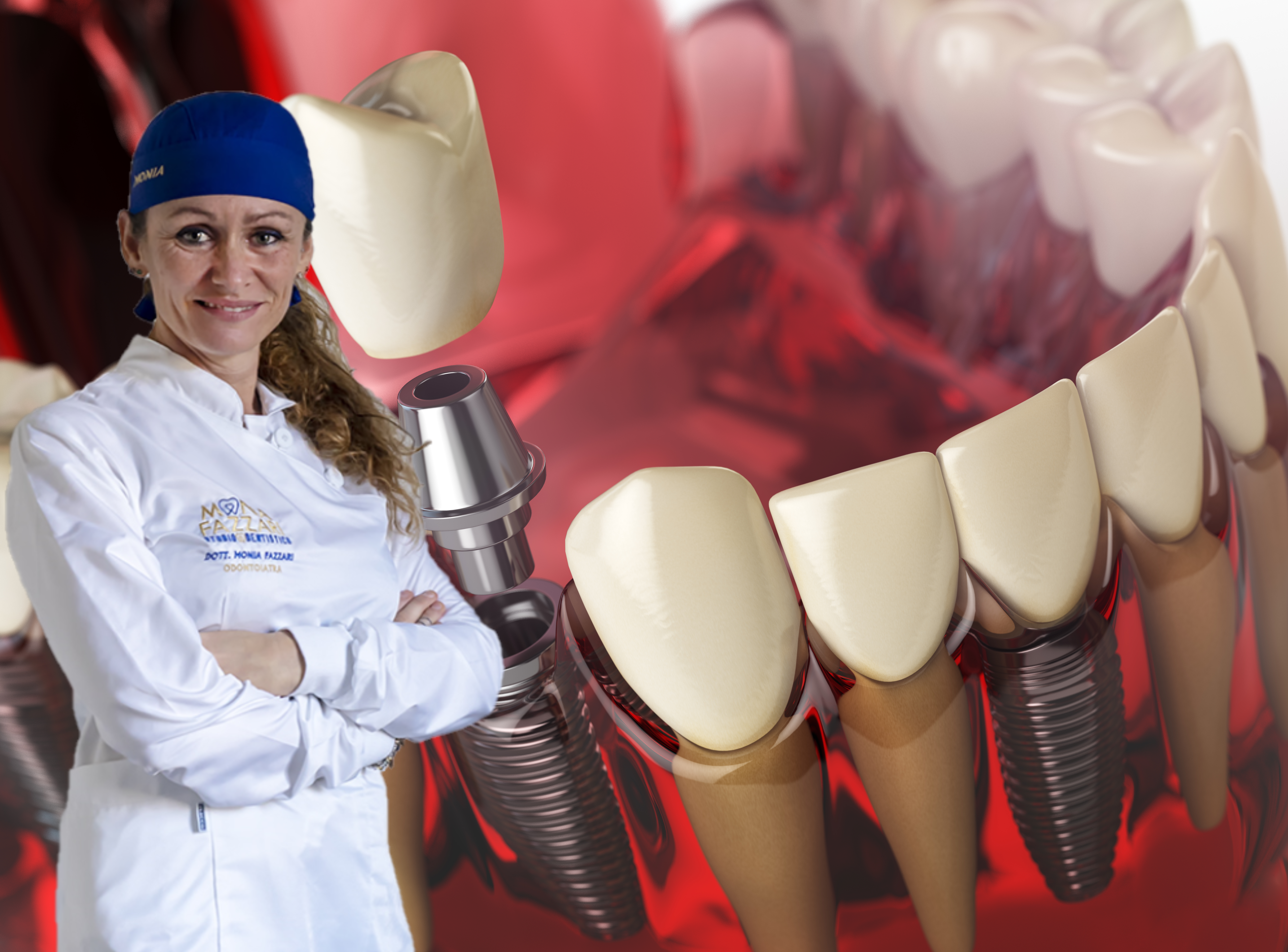 impianti dentali