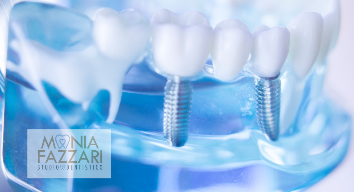 impianti dentali- cura impianti dentali - mantenimento impianti dentali
