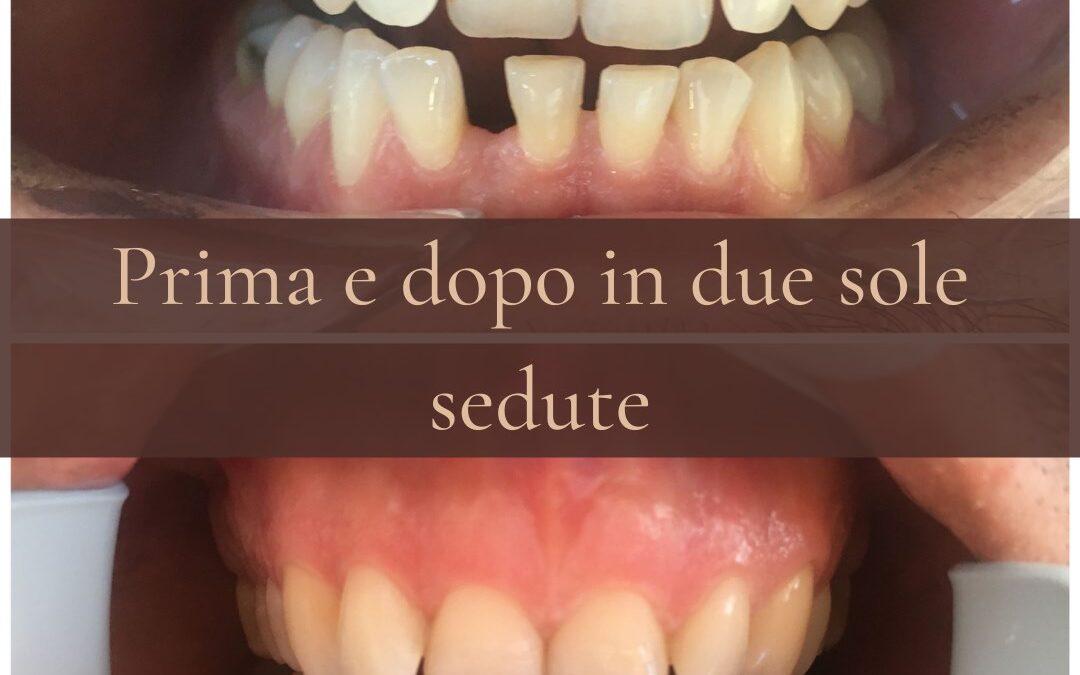 faccette dentali