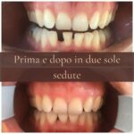 faccette dentali